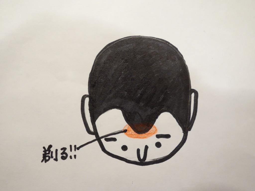 M字型の薄毛8